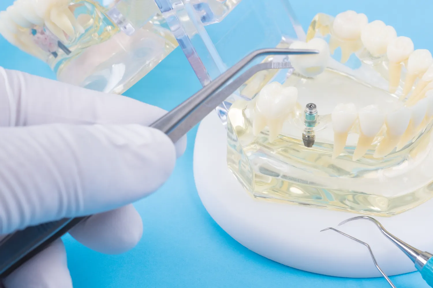 Implanty zębów - przeciwwskazania