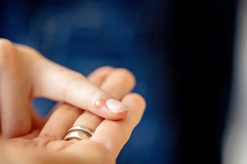 Podolog usuwanie kurzajek